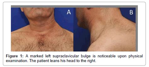 Supraclavicular Fossa Swelling