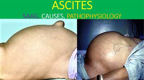 Ascites analysis explained - YouTube