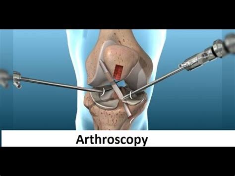 Understanding Arthroscopy: What to Expect Before, During, and After the ...