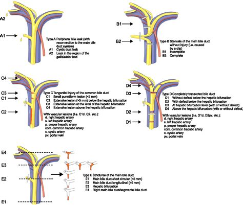 Figure From Recent Classifications Of The Common Bile Duct Injury