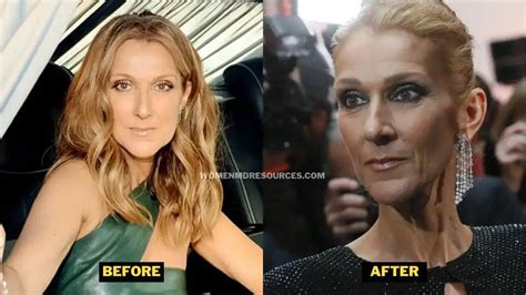 Celine Dion Health Condition, Illness & Disease Update