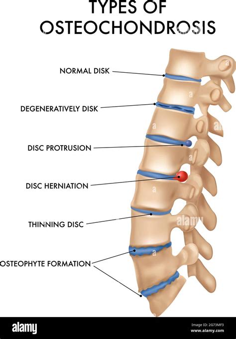 Esquema De La Columna Vertebral Humana Im Genes Vectoriales De Stock