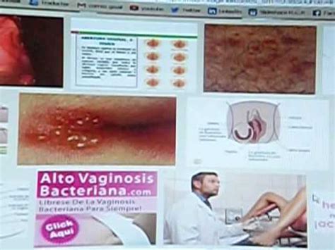 Espinillas Vaginales Youtube