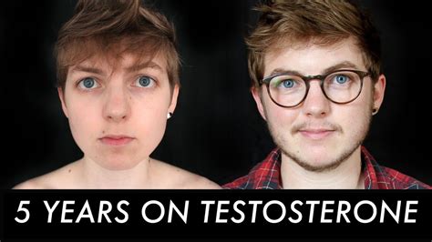 Changes From Years On Testosterone Transition Update Youtube