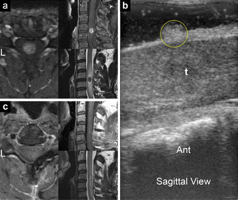 A Preoperative Axial Sagittal T1 Weighted Post Contrast And