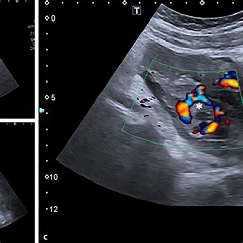 Abb 1 8 Tubal Ring Sign Bei Einer 27 Jährigen Patientin Mit Starken Download Scientific