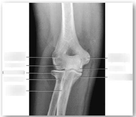 AP Elbow X Ray Diagram Quizlet