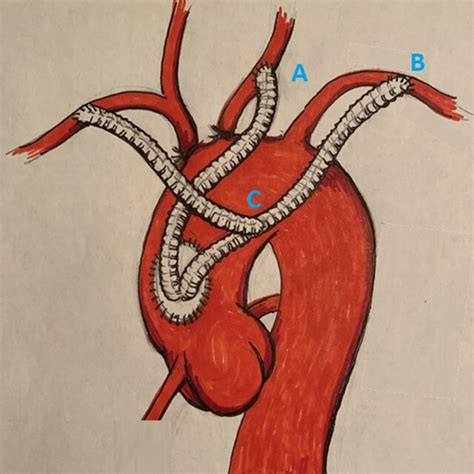 The Re Arching Technique Bypass Grafts To The Aortic Arch Branches A Download Scientific