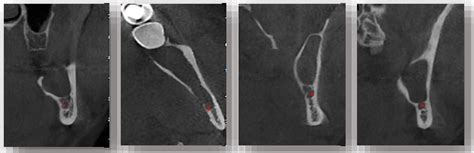 Figure From Conservative Management Of Keratocystic Odontogenic Tumor