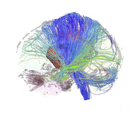 Dti Mri Brain