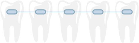 Braces PNGs for Free Download