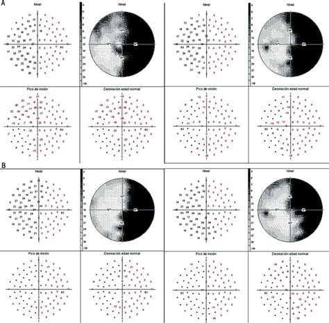 Visual Field Tests Showing An Absolute Homonymous Right Hemianopia And Download Scientific