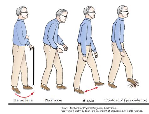 Ataxia Causas S Ntomas Y Tratamientos