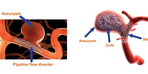 Cerebral Aneurysms Dr Rao Is The Best In Both Open And Endovascular