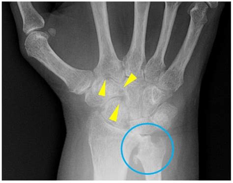 Diagnostics Free Full Text Radiographic Findings Of Inflammatory Arthritis And Mimics In The