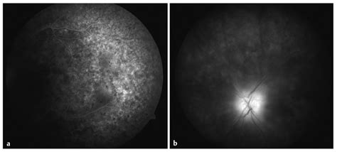 Intraocular Lymphoma Ento Key