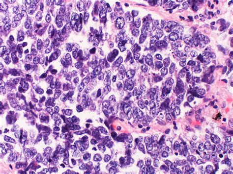 Large Cell Neuroendocrine Carcinoma Large Cells With Nucle Flickr