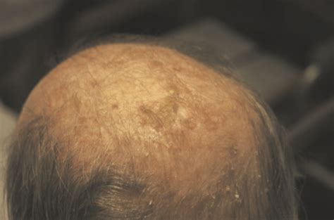 Queratosis actínicas Dr Sergio Niklitschek Dermatólogo Puerto Varas