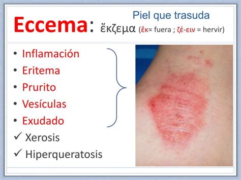 Diferencias Entre Dermatitis Atópica Y Urticaria Prof Ortega Martell