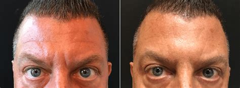 Male Botox For Forehead Lines And Frown Lines Before And After Photos New Jersey Reflections Center