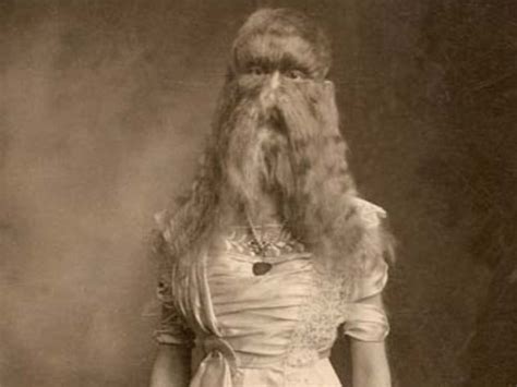 Hypertrichosis Girl