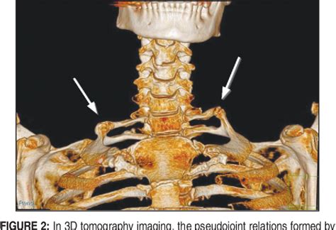 Figure 2 From Pseudoarthrosis Of Cervical Rib And 1st Rib Exocytosis In A Patient Presenting