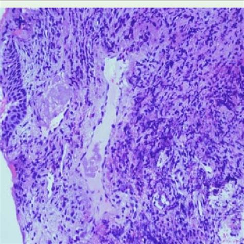 Histopathological Findings Of The Subglottic Lesion Biopsy Specimen