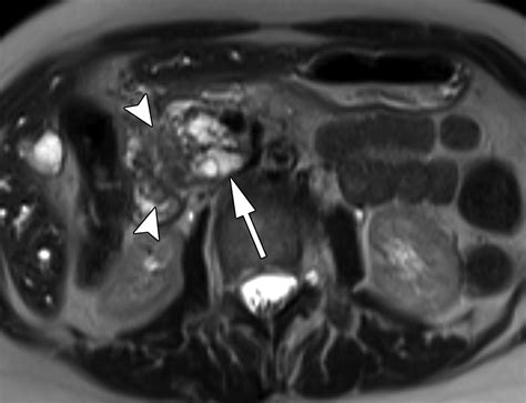 Mr Imaging Of Cystic Lesions Of The Pancreas Radiographics