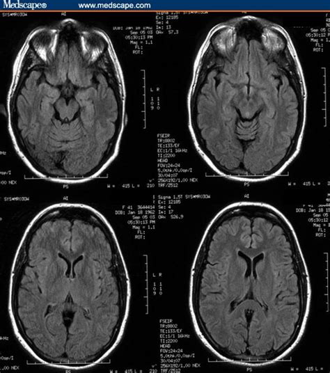 Pseudotumor Cerebri Mri