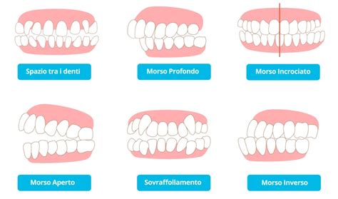 Malocclusioni Dentali Cosa Sono ADC Dental Center Milano