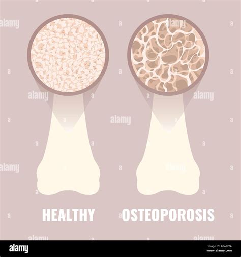 Osteoporosis Conceptual Illustration Stock Photo Alamy