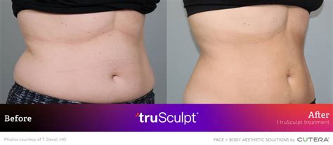 Discover Trusculpt Non Surgical Body Contouring Acml