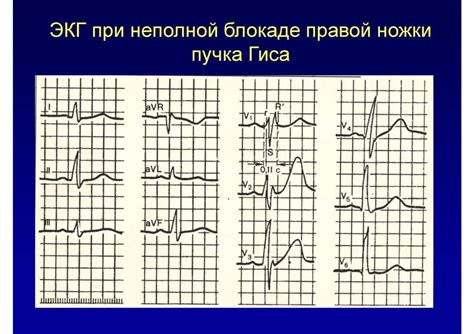 Нарушение ритма сердца - презентация онлайн