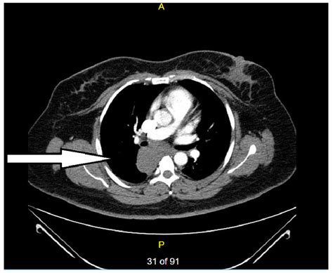 Ct Abdomen With Contrast With Chest Window Showing Right Subcarinal