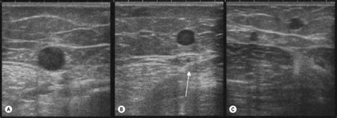 Ultrasound image of great saphenous vein in the fascia layer Vascular Ultrasound, Ultrasound ...