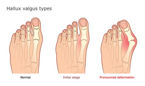 Hallux Valgus Bunion Dr Mohamed Attia Md Phd