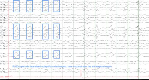 Eeg Fun Facts Lateralized Periodic Discharges Dec