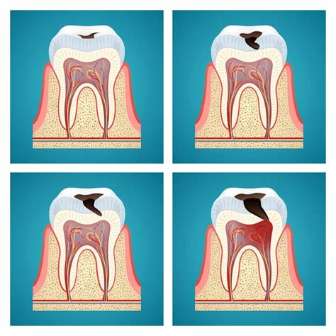 Caries Dental Vector Gráfico Vectorial Imágenes De Caries Dental