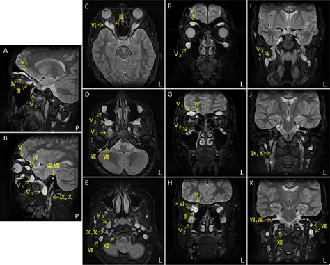 Cranial Nerves Axial Mri