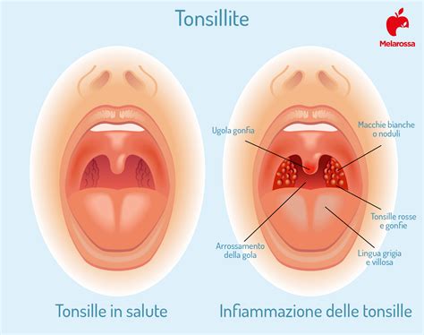 Placche In Gola Cosa Mangiare Hotsell Blog Websoft9