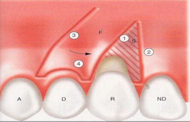 Flap Techniques In Dentoalveolar Surgery Intechopen