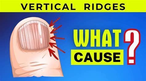 Top 6 Cause Of Vertical Ridges On Your Nails Youtube