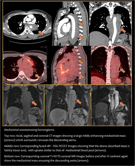 Ep14 03 12 Anastomosing Hemangioma Of Mediastinum And Pleura Mimicking