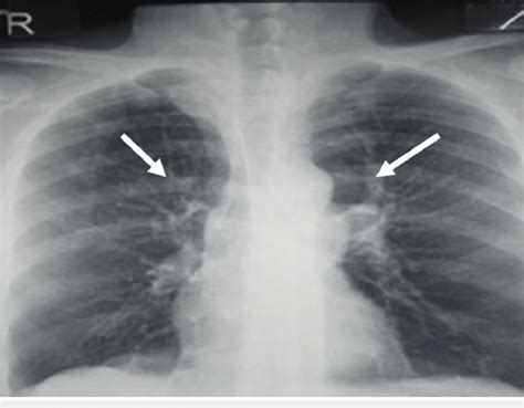 Chest X Ray Showing Linear Opacity Associated With Retraction Signs In Download Scientific