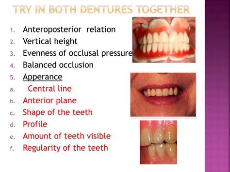 Ppt Try In Of Complete Dentures Powerpoint Presentation Id4997759