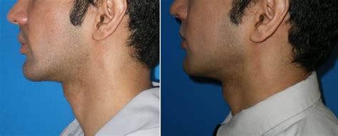 Facial Implants For Men Richmond Va Facial Cosmetic Surgery For Men