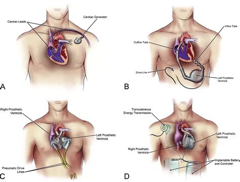 Cardiac Implantable Electronic Devices – iHEAL Medical Centre