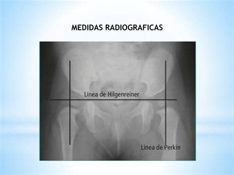 Displasia Congenita De Cadera Ppt