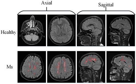 Multiple Sclerosis Vs Normal Brain Mri | Hot Sex Picture