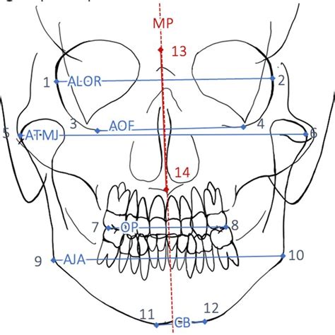 Radiological Landmarks And Axes As Described In Table 3Error Reference